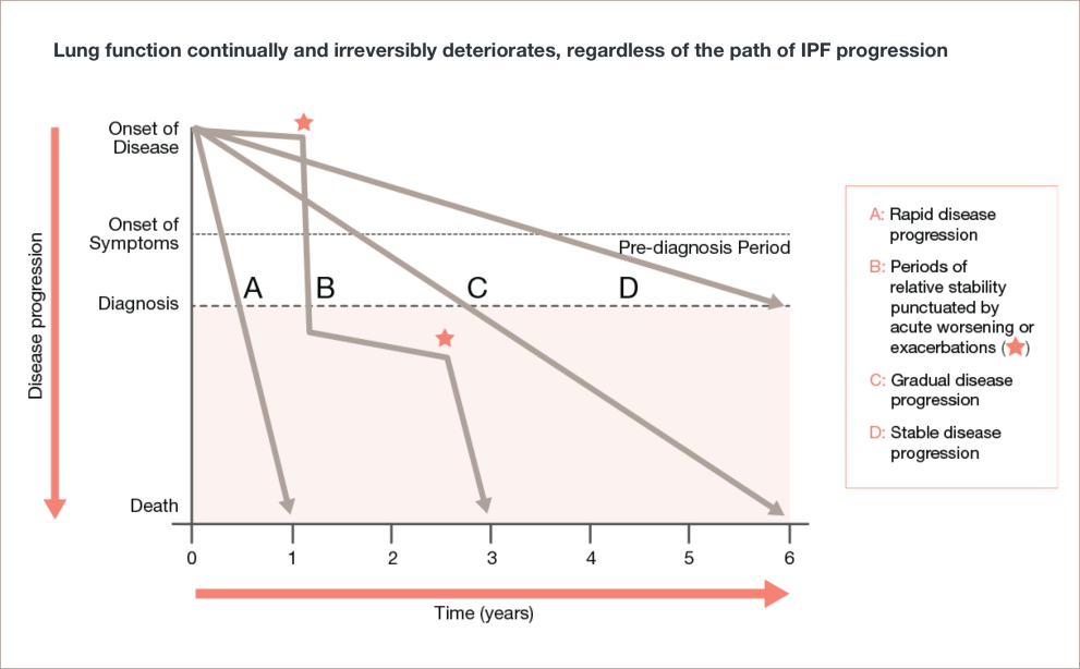 Graph showing disease progression in IPF. Click graph full text for description.