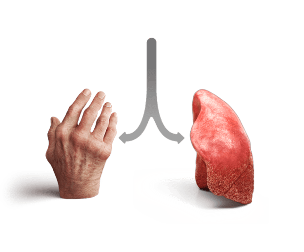 Faites le lien entre les MRAS et la MPI.